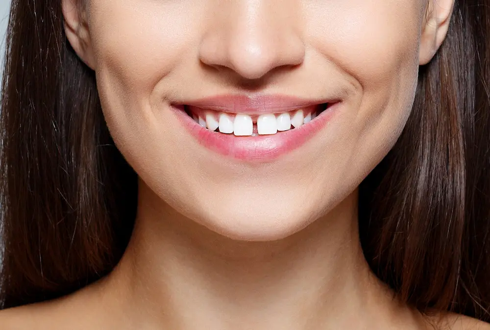 Diastema dental
