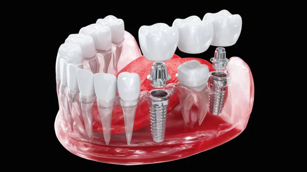 Puente dental como funciona