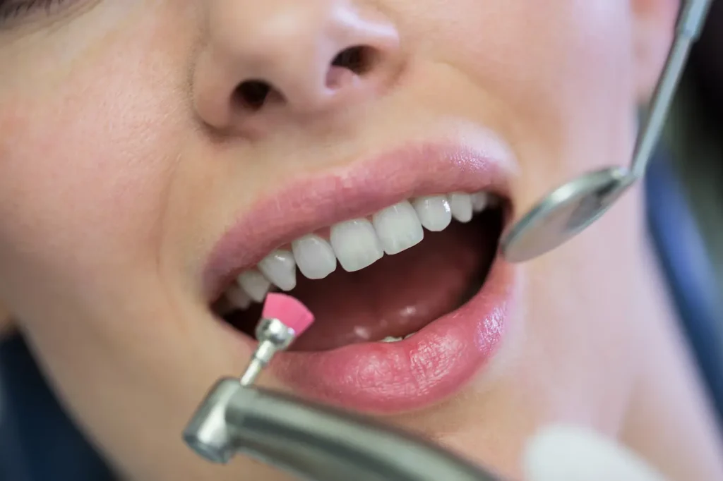 Limpieza dental