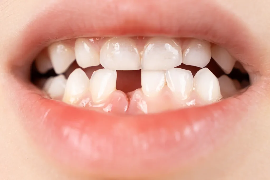 salida de dientes