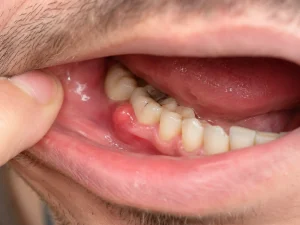 absceso dental
