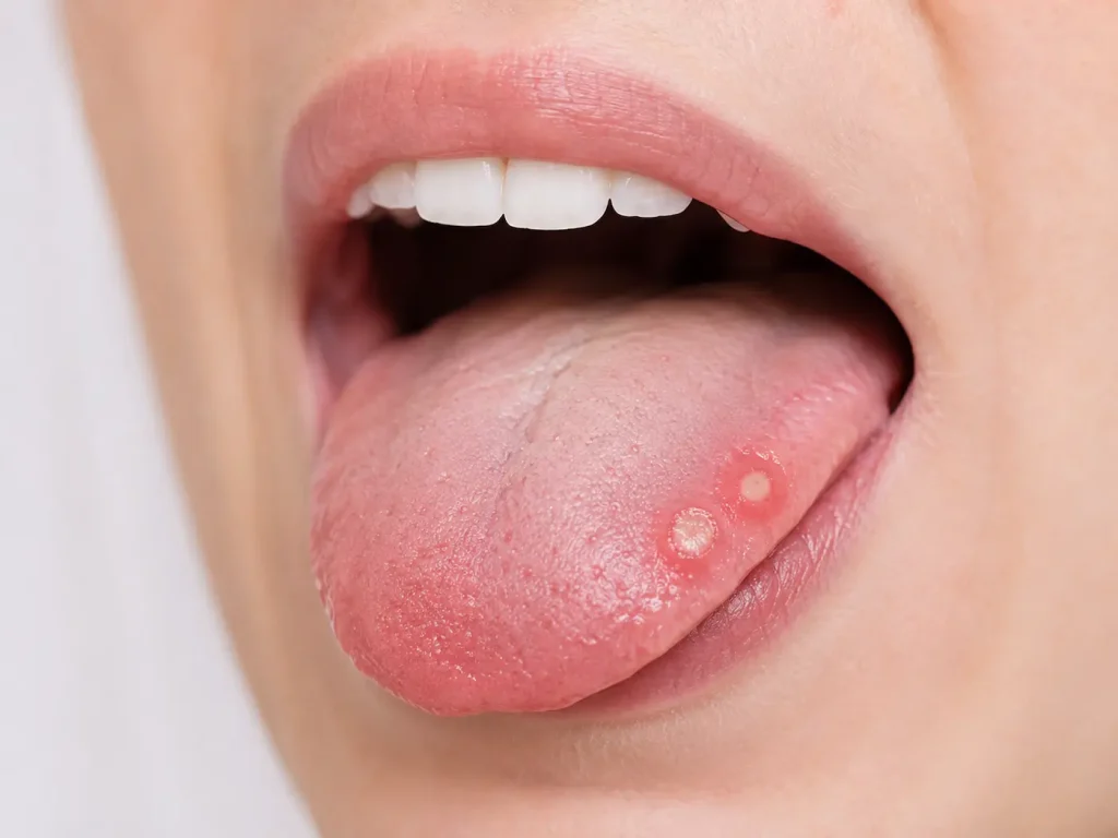 aftas en la lengua