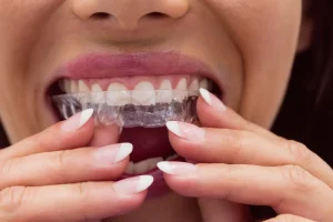 férula dental