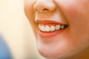 sonrisa gingival